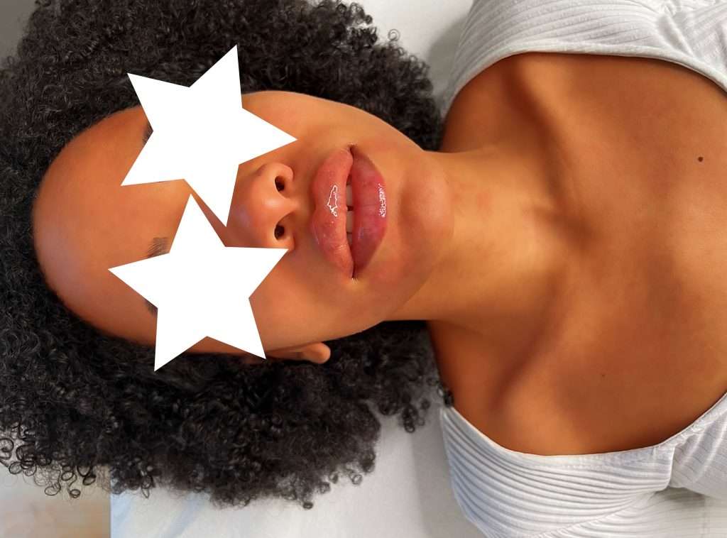 Filler labbra